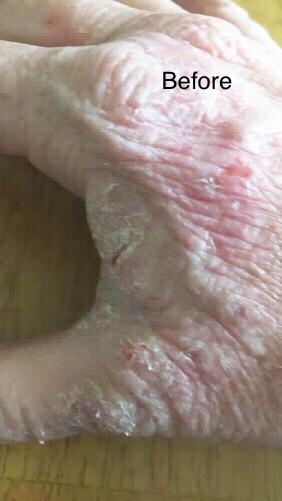 “No More Eczema” Organic Soap Bar – Gentle Unscented Cleanser for Sensitive Skin